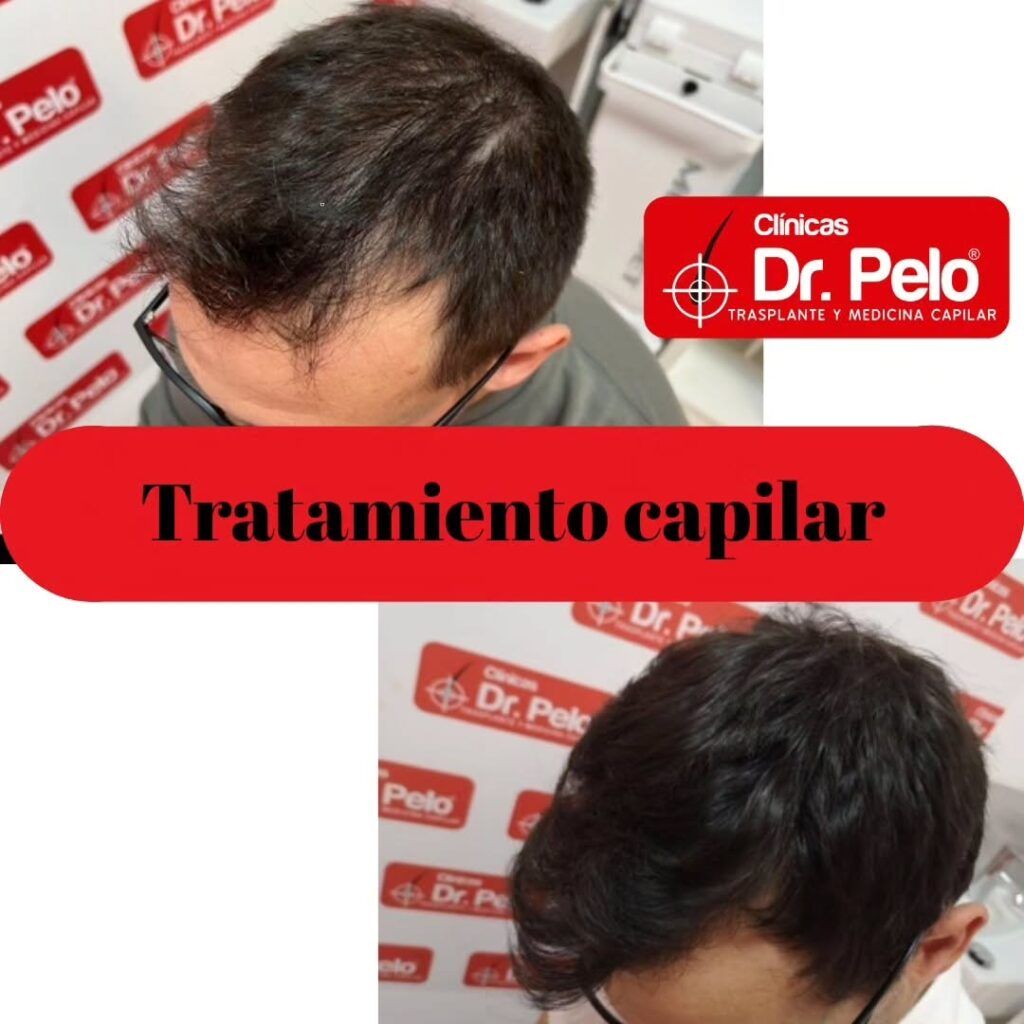 tratamiento-capilar-online