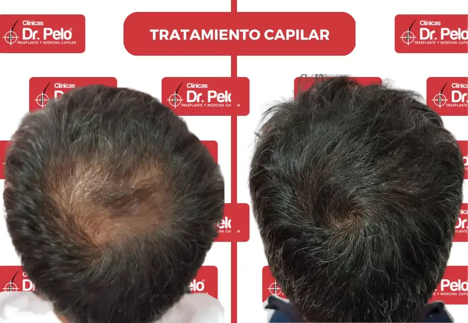 clinica-tratamiento-capilar.webp