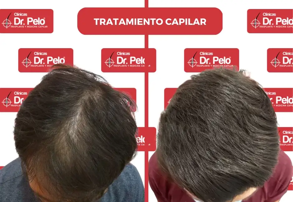 clinicas-tratamiento-capilar.webp