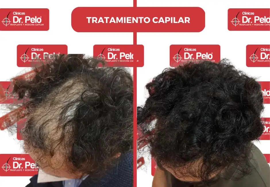 evolucion-tratamiento-capilar-1.webp
