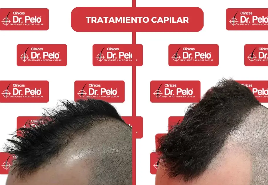 tratamiento-capilar-antes-despues.webp